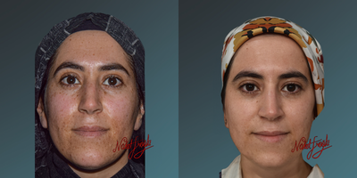 35-44 year old woman treated with Fraxel Laser - 35-44 year old woman treated with Fraxel Laser
