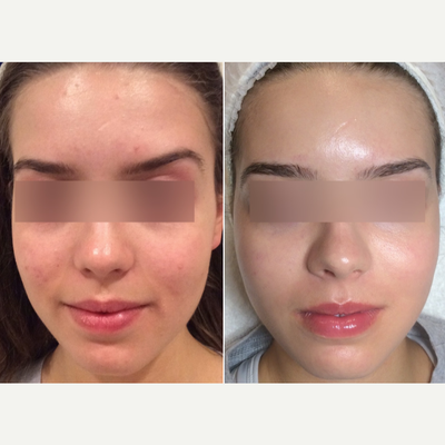 18-24 year old woman treated with Dermalinfusion - Post 1 Dermalinfusion and Laser Genesis treatment, same day!