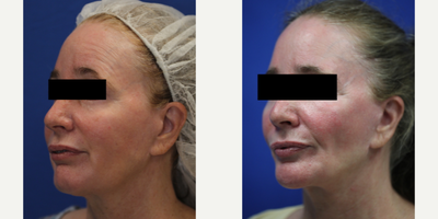 55-64 year old woman treated with Silicone Injection Removal - Meet our resilient patient, a 55-year-old white female standing at 5'1 and weighing 117 pounds. She had silicone injected into her face and unfortunately experienced numerous health issues as a result. Concerned for her wellbeing, she turned to the renowned Dr. J. Timothy Katzen in Beverly Hills, CA, for help.Dr. Katzen skillfully removed the silicone from her face, providing her with much-needed relief. Our patient now feels much better and is grateful for the compassionate care she received. Her journey is a reminder of the importance of seeking out qualified professionals when considering cosmetic procedures and the potential dangers of unregulated treatments.