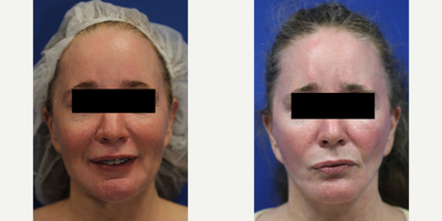 55-64 year old woman treated with Silicone Injection Removal - Meet our resilient patient, a 55-year-old white female standing at 5'1 and weighing 117 pounds. She had silicone injected into her face and unfortunately experienced numerous health issues as a result. Concerned for her wellbeing, she turned to the renowned Dr. J. Timothy Katzen in Beverly Hills, CA, for help.Dr. Katzen skillfully removed the silicone from her face, providing her with much-needed relief. Our patient now feels much better and is grateful for the compassionate care she received. Her journey is a reminder of the importance of seeking out qualified professionals when considering cosmetic procedures and the potential dangers of unregulated treatments.