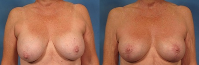71 year old breast implant revision - 
	This 71 year old female was concerned with the appearance of her breasts after prior subglandular (above the muscle) saline breast augmentation with capsular contracture. The patient elected to replace the implants with slightly smaller silicone implants and to have a breast lift to help elevate the nipples bilaterally. Surgeon: Dr. Hasen Patient Age: 71 Height: 5'3 Weight Before: 148 lbs Weight After: 148 lbs Patient Gender: Female Implant Size Left: 339 cc Implant Size Right: 339 cc Breast Incision Type: Vertical Chest Measure Before: 36 inches Chest Measure After: 34 inches Cup Size Before: D Cup Size After: D
