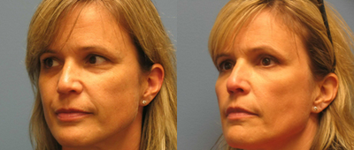 Woman in 40s treated for wrinkles - Upon meeting with the patient, Dr. Berkowitz learned she was concerned with wrinkles appearing around her eyes and the sides of her cheeks. To reverse these signs of aging, the patient was treated with RADIESSE to help eliminate the wrinkles. The result was a much smoother face, with eye and edge of mouth, cheek, wrinkles all but having disappeared.