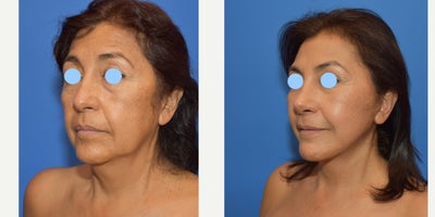 65-74 year old woman treated with Facelift, Rhinoplasty, Neck Lift, Chin Liposuction - Woman treated with Facelift, Rhinoplasty, Neck Lift, Chin Liposuction