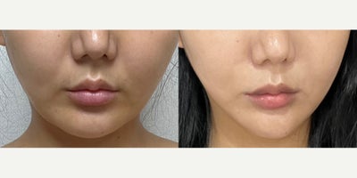 25-34 year old woman treated with Lipodissolve - Fat-dissolving injections to contour the facial line