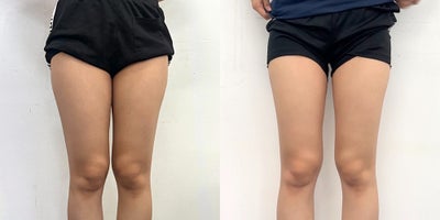 25-34 year old woman treated with Lipodissolve - Fat-dissolving injections to contour the thighs