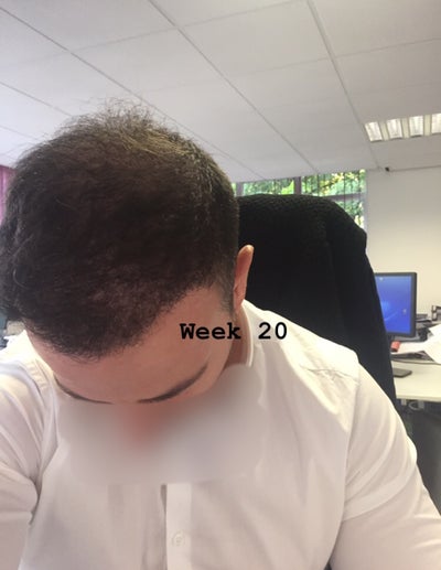 Hair Of Istanbul Hair Transplant On 16th April 2018 Review