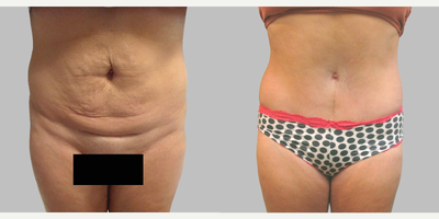 Mini Tummy Tuck - 42 year old mother after mini-abdominoplasty to remove extra skin and tighten abdominal muscle.