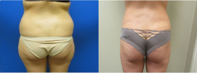 18-24 year old woman treated with Liposuction - She had some fullness of the lower back and outer thighs she wanted removed. Dr. Reno removed 2500cc total with tumescent liposuction. Postoperative photos were taken 1 year after surgery.