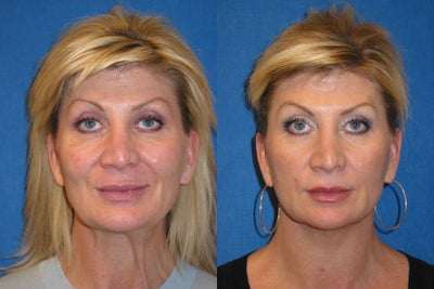 Woman treated with Ultherapy - Woman treated with Ultherapy