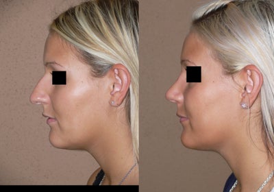 Nose job - rhinoplasty - 
	Nose job - rhinoplasty
