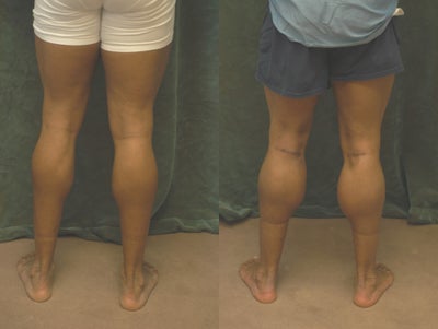 Men's Calf Augmentation  - 
	Men&#39;s Calf Augmentation W/Implants
