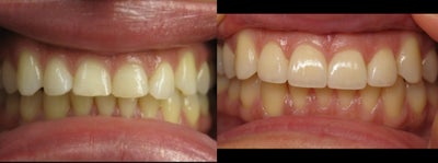 Veneers Before & After Photo - 
	Patient had veneers placed on upper 4 anterior teeth.
