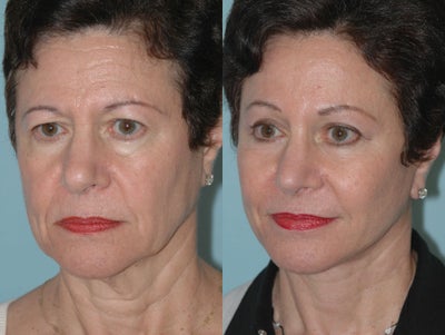 Facelift Surgery - 
	Before and after facelift surgery
