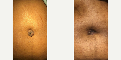 55-64 year old woman treated with Keloid Scar Removal - Patient has a previous keloid directly in her Umbilicus from previous surgery. The keloid is surgically removed and replaced with full thickness skin graft. She has healed nicely post treatment with a naturally appearing umbilicus.