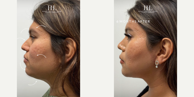 Woman treated with Jaw Reduction - Woman treated with Facial Feminization Surgery through coronal approach to a brow bone and supraorbital bone reduction, a direct Brow Lift, Neck Lift, Facelift, Jaw Reduction, T Genioplasty, Buccal Fat Removal, and a closed Rhinoplasty. Patient is shown before and 6 months post-op.