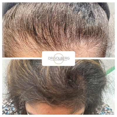 25-34 year old woman treated with Hair Loss Treatment, PRP for Hair Loss, PRF Treatment - Dr. Golberg is renowned for his holistic approach. The G-Lift procedure he offers not only lifts the lower third of the face but also uses bio-stimulating agents to enhance the upper areas. This comprehensive method ensures a balanced and rejuvenated appearance. In just one hour, the G-Lift can deliver remarkable results, combining thread lifts with bio-stimulation for a youthful transformation.