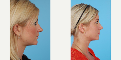 23 year old man treated with Rhinoplasty - A 23 year-old woman before and after Rhinoplasty by Andrew Lyos M.D FACS.