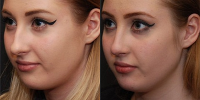 Woman treated with Rhinoplasty - Rhinoplasty