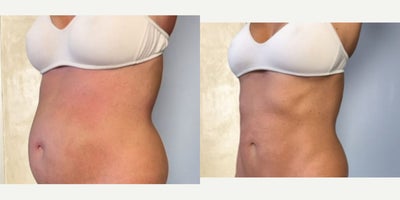 45-54 year old woman treated with Semaglutide, Evolve - Evolve body treatment for muscle building combination of semaglutide - treated by Alyssa G and Tracy Kwan, PA