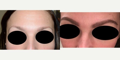 35-44 year old woman treated with Eyebrow Transplant - Before and after eyebrow transplant.