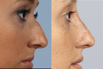35-44 year old woman treated with Non Surgical Nose Job - 35-44 year old woman treated with Non Surgical Nose Job