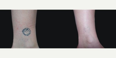 45-54 year old woman treated with Tattoo Removal - 47 year old female received 10 tattoo removal treatments, photos represent before and 10 weeks post-op from their 10th treatment.
