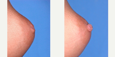 18-24 year old woman treated with Nipple Surgery - This 22 year old woman is seen one year after correction of her inverted nipple deformity. Scarring is excellent and all sensation has been preserved!
