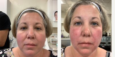 35-44 year old woman treated with Pelleve - Vampire facelift with PRP and HA Filler