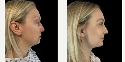 25-34 year old woman treated with Facelift, Neck Lift - A deep plane facelift and necklift in a 40 year old patient