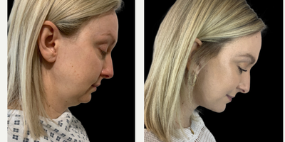 25-34 year old woman treated with Facelift, Neck Lift - A deep plane facelift and necklift in a 40 year old patient
