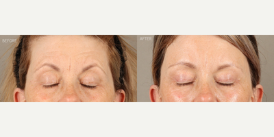 Temporal Brow Lift, Upper Blepharoplasty and Full-Face Fractionated CO2 Laser - 58-year-old female who was concerned about her eyes looking tired. She is shown 6 months after a temporal (lateral) endoscopic-style brow lift, upper blepharoplasty and full-face fractionated CO2 laser. The combination of surgeries created a more youthful upper eye contour, relieved tension on her forehead and refreshed her skin.