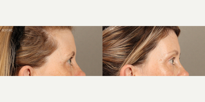 Temporal Brow Lift, Upper Blepharoplasty and Full-Face Fractionated CO2 Laser - 58-year-old female who was concerned about her eyes looking tired. She is shown 6 months after a temporal (lateral) endoscopic-style brow lift, upper blepharoplasty and full-face fractionated CO2 laser. The combination of surgeries created a more youthful upper eye contour, relieved tension on her forehead and refreshed her skin.