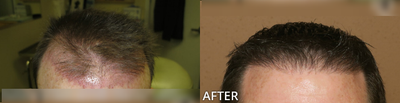 Man treated with Hair Transplant, ARTAS Robotic Hair Transplant - Man treated with Hair Transplant, ARTAS Robotic Hair Transplant