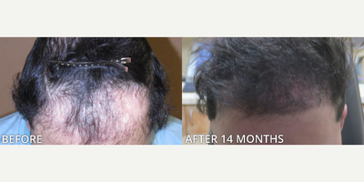 Man treated with Hair Transplant, ARTAS Robotic Hair Transplant - Man treated with Hair Transplant, ARTAS Robotic Hair Transplant