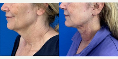 Female treated with MyEllevate - MyEllevate with Renuvion treatment.