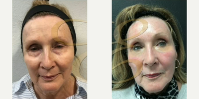 Woman treated with Laser Resurfacing - Woman treated with Laser Resurfacing