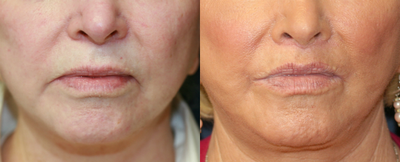 Corner of Lip Lift for Sad Expression - 
	Before and two months after lip procedure to improve sad expression created by downturned frowning corners.
