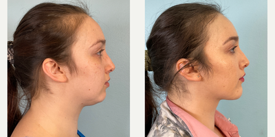 25-34 year old woman treated with Buccal Fat Removal, Chin Implant, Chin Liposuction, Morpheus8 - 25-34 year old woman treated with Buccal Fat Removal, Chin Implant, Jawline Sculpting, Morpheus8
