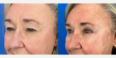 65-74 year old woman treated with Eyelid Surgery - Patient had bi-lateral upper and lower blepharoplasty and brow pexy