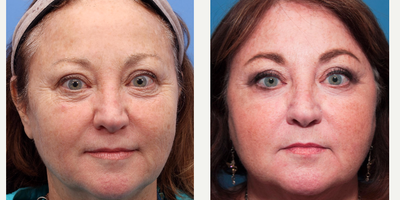 55-64 year old woman treated with Pixel Laser - Facial skin tightening and improvement in skin tone after two treatments with Pixel Laser.
