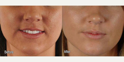 Woman treated with Microdermabrasion - Woman treated with Microdermabrasion