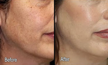 Woman treated with Microdermabrasion - Woman treated with Microdermabrasion