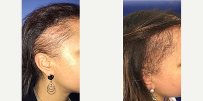 25-34 year old woman treated with Hair Loss Treatment - Patient is 8 months post op her PRP procedure