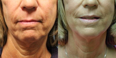 55-64 year old woman treated with Profound RF - This patient hadProfound RF treatment done. This set of pictures were only 5 weeks apart.