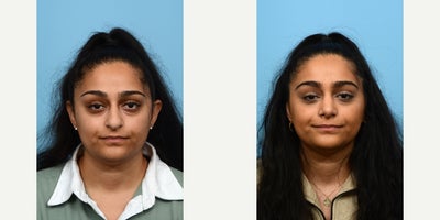 25-34 year old woman treated with Septoplasty - This 28-year-old patient felt very unhappy with the size and shape of her nose, as she had been self-conscious about it her entire life. The doctorperformed a rhinoplasty to deemphasize the bump and make the tip smaller. 7 weeks post-op.