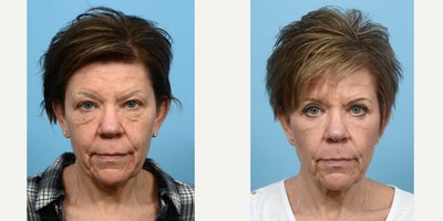 45-54 year old woman treated with Double Eyelid Surgery - upper & lower blepharoplasty and co2 laser skin resurfacing