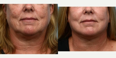 65-74 year old woman treated with Laser Resurfacing - This 65-year-old patient wanted to reverse the signs of aging. The doctor performed a facelift along with CO2 laser skin resurfacing, to further enhance the patients results. 2 months post-op.