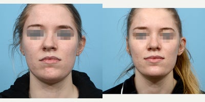 18-24 year old woman treated with Septoplasty - This patient reached out to Dr. Wise with a complicated rhinoplasty case, looking to correct her nose structure, shape, size, asymmetry, and breathing issues. After a lot of work on the septum, Dr. Wise was able to construct a new, natural-looking nose for her. Six weeks post-op, she's thrilled to have a nose that complements the rest of her facial features.
