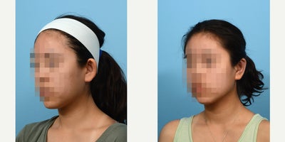 18-24 year old woman treated with Earfold - Six weeks post - otoplasty with Dr. Wise in New Jersey, this 18-year-old patient is very happy her ears no longer stick out. She also noted that the recovery was much easier than she had anticipated.
