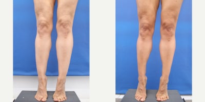 45-54 year old woman treated with Liposuction, Laser Liposuction, Tumescent Liposuction, Power-Assisted Liposuction (PAL), Calf  - Before and 7 months after Precision Sculpt awake liposuction or Ankles and Calves.